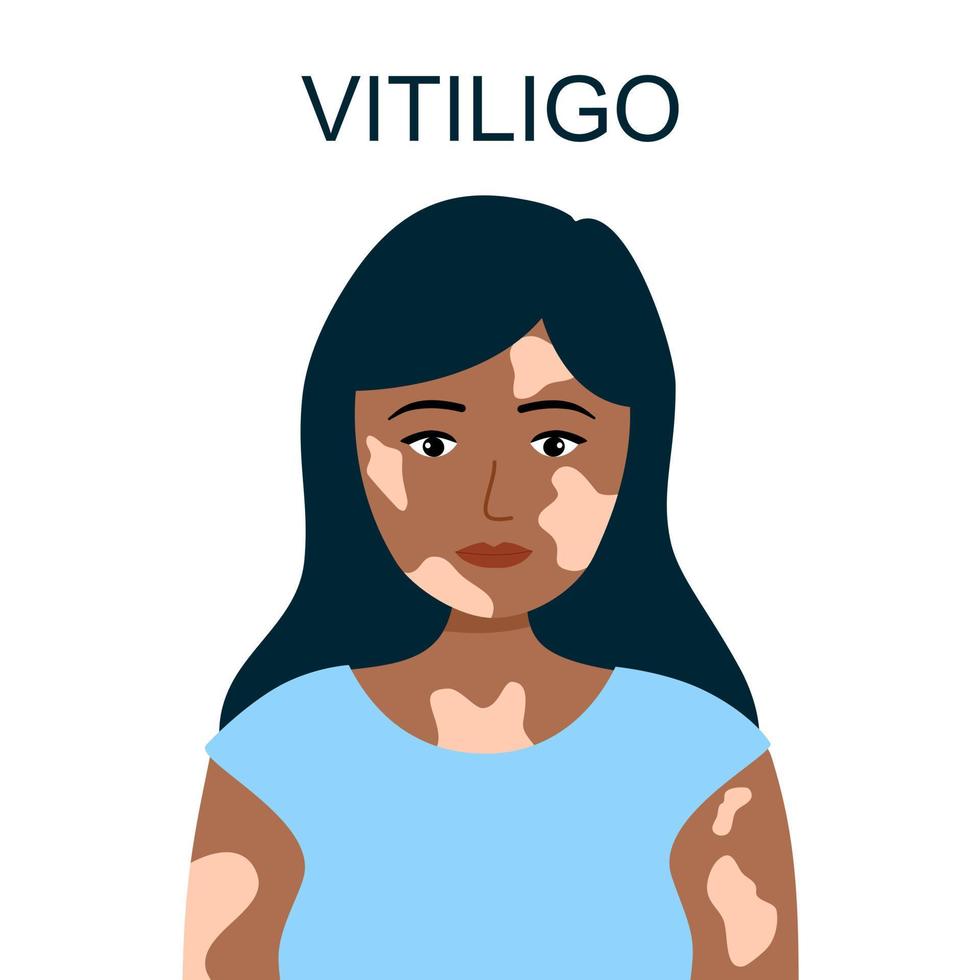 Vitiligo Treatment